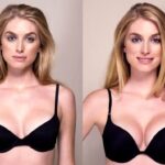 De ce este important un lifting mamar