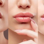 Ce trebuie sa stii despre procedura de marire buze?