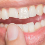 Cum se poate trata fisura dentara?