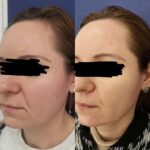 Scapa de pori dilatati cu ajutorul tratamentului cu laser