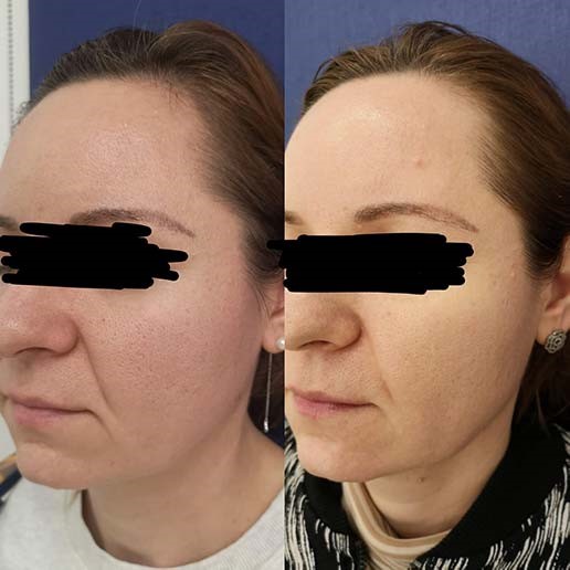 Scapa de pori dilatati cu ajutorul tratamentului cu laser