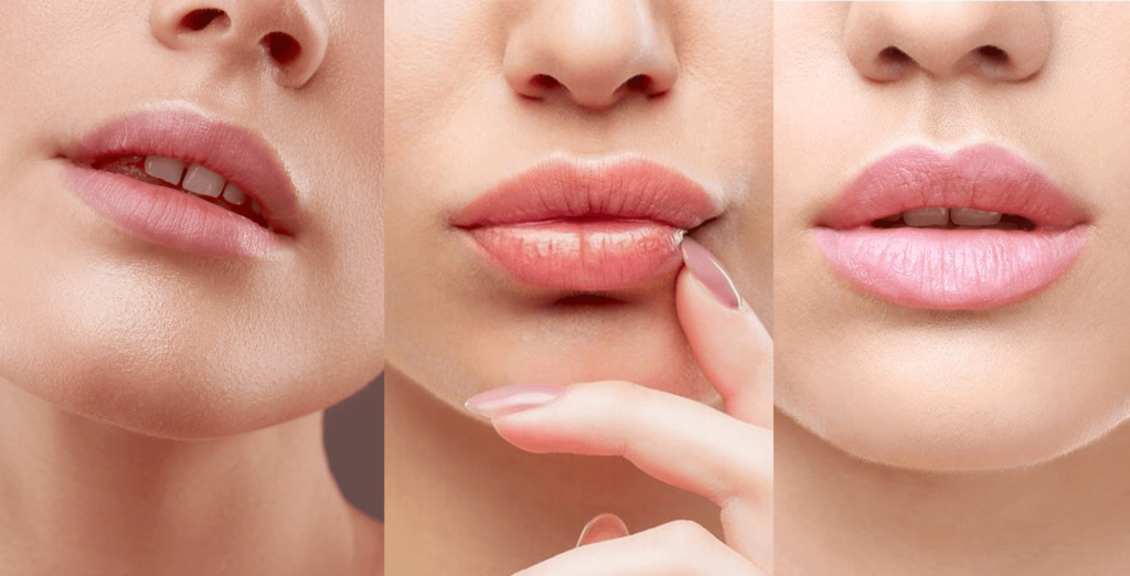 Ce trebuie sa stii despre procedura de marire buze?